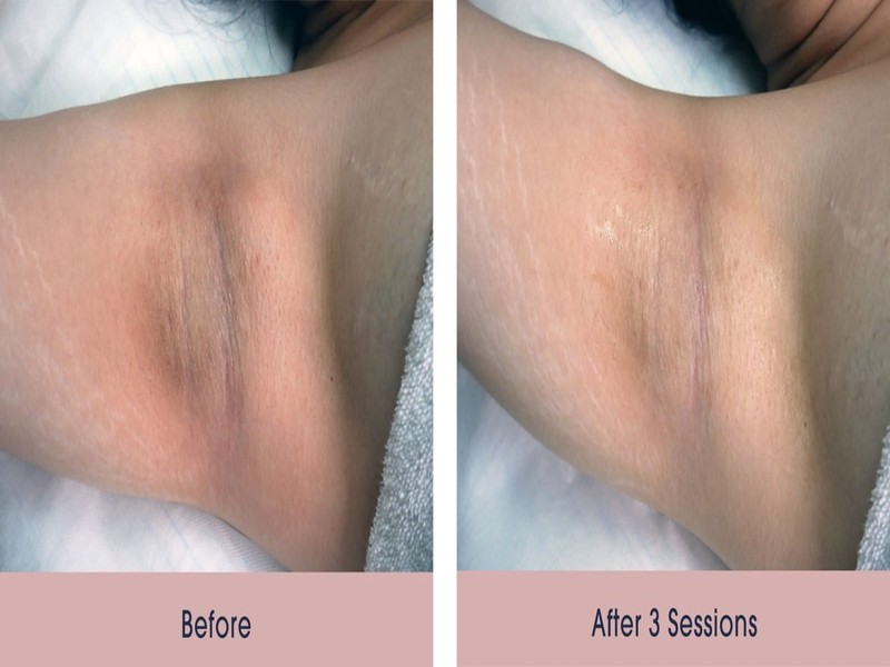 Underarm Care How to Manage and Prevent Ingrown Hairs